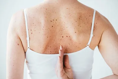 IDO'S Clinic: Pigmented spots and moles on the back, illustrating skin treatments